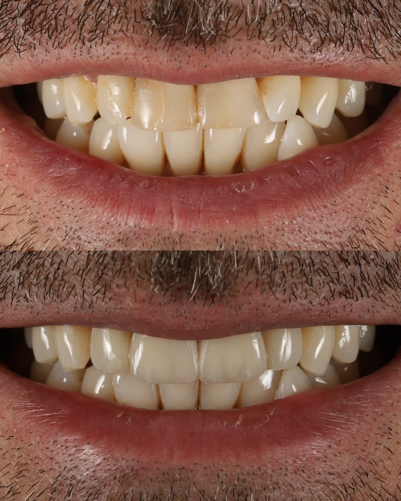 Caso de estética dental 6